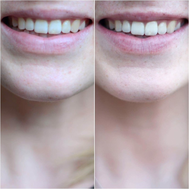 Listerine Advanced White MultiAction Mouthwash Brand Advisor