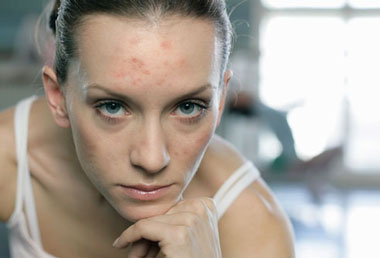 Is adult acne common?