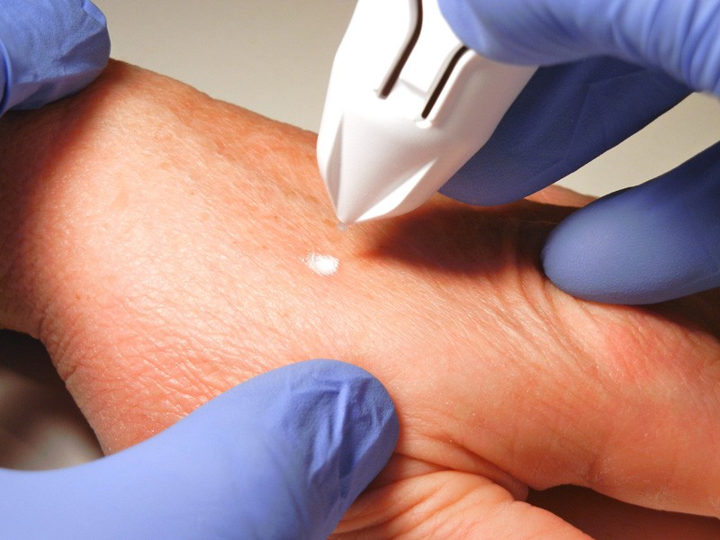 Hand Rejuvination: Laser Skin Resurfacing